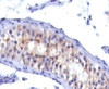 IHC testing of testicular carcinoma with Prolactin receptor antibody (PRLR742) .