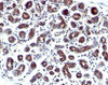 IHC staining of human breast cancer with Estrogen Inducible Protein pS2 antibody.