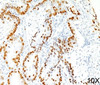 IHC staining of human lung adenocarcinoma (10X) with TTF-1 antibody (8G7G3/1) .