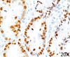 IHC staining of human lung adenocarcinoma (20X) with TTF-1 antibody (8G7G3/1) .