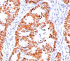 IHC staining of human colon carcinoma with p53 antibody (BP53-12) .
