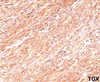 Formalin/paraffin human gastrointestinal stromal tumor (10X) stained with TMEM16A antibody (DG1/447) .