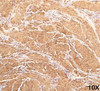 IHC staining of human leiomyosarcoma (10X) with Muscle actin antibody (HHF35) .