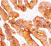IHC testing of FFPE human colon carcinoma and Multi Cytokeratin antibody (clone C11) .