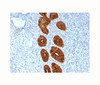 Epithelial Marker Antigen antibody IHC testing of formalin-paraffin human endometrial cancer tissue.