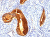 IHC staining of FFPE human endometrial carcinoma with MUC-1 antibody. HIER: boil tissue sections in pH6, 10mM citrate buffer, for 10-20 min and allow to cool before testing.