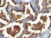 IHC staining of FFPE human lung carcinoma with MUC-1 antibody. HIER: boil tissue sections in pH6, 10mM citrate buffer, for 10-20 min and allow to cool before testing.