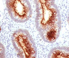 FFPE staining of human colon carcinoma with CEA antibody C66/1030.