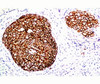 FFPE staining of human breast carcinoma with HER-2 antibody (ERB2/776) .