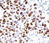 Formalin-fixed, paraffin-embedded human lung squamous cell carcinoma (SCC) stained with p21 antibody (CIP1/823) .