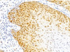 Formalin-fixed, paraffin-embedded human cervical cancer stained with p27 antibody (DCS-72.F6)