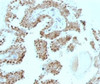 Formalin-fixed, paraffin-embedded human prostate carcinoma stained with p57Kip2 antibody (SPM308) .