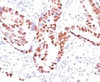 Formalin-fixed, paraffin-embedded human colon carcinoma stained with p57 antibody (KIP2/880) .