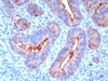 Formalin-fixed, paraffin-embedded human colon carcinoma stained with CEA antibody (C66/195) .