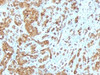 Formalin-fixed, paraffin-embedded human melanoma stained with Melan-A antibody (MLANA/788) .