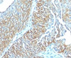 Formalin-fixed, paraffin-embedded human esophageal carcinoma stained with TRIM29 antibody (TRIM29/1041) .