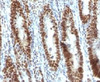 Formalin-fixed, paraffin-embedded human gastric carcinoma stained with TOX3 antibody (TOX3/1123) .