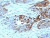 Formalin-fixed, paraffin-embedded human colon carcinoma stained with Blood Group Antigen H Type 2 antibody (19-OLE)