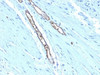 Formalin-fixed, paraffin-embedded human colon carcinoma stained with Blood Group Antigen A antibody (HE-193)