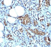 Formalin-fixed, paraffin-embedded human angiosarcoma stained with Glycophorin A antibody (GYPA/280)