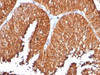 Formalin-fixed, paraffin-embedded human bladder carcinoma stained with anti-HSP60 antibody (SPM253)