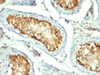 IHC testing of FFPE human testicular carcinoma with HSP60 antibody