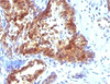 Formalin-fixed, paraffin-embedded human prostate carcinoma stained with Prostate Specific antibody (KLK3/1248) .