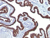 Formalin-fixed, paraffin-embedded ovarian carcinoma stained with Cytokeratin 7 antibody (OV-TL12/30)