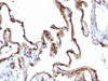Formalin-fixed, paraffin-embedded human lung carcinoma stained with Keratin 7 antibody (KRT7/1198)