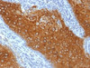 IHC testing of FFPE human skin with Keratin 10 antibody (clone KRT10/844) . Required HIER: boil tissue sections in 10mM citrate buffer, pH 6.0, for 10-20 min.