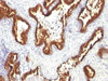 Formalin-fixed, paraffin-embedded human prostate carcinoma stained with Keratin 18 antibody (KRT18/1190) .