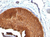 Formalin-fixed, paraffin-embedded human bladder carcinoma stained with Cytokeratin 19 antibody (KRT19/799)