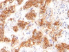 Formalin-fixed, paraffin-embedded human breast carcinoma stained with MFG-E8 antibody (SPM291)