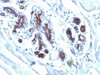 Formalin-fixed, paraffin-embedded human breast carcinoma stained with Lactadherin antibody (EDM45)