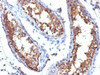 Formalin-fixed, paraffin-embedded human testicular carcinoma stained with CD99 antibody (HO36-1.1) .