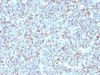 Formalin-fixed, paraffin-embedded human Ewing's sarcoma stained with anti-CD99 antibody (SPM596) .