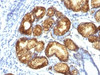 Formalin-fixed, paraffin-embedded human gastric carcinoma stained with MUC6 antibody (CLH5) .