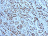 IHC testing of FFPE gastric carcinoma with MUC6 antibody (clone CLH5) . HIER: steam section in pH6 citrate buffer for 20 min and allow to cool prior to tetsting.