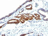 Formalin-fixed, paraffin-embedded human gastric carcinoma stained with anti-MUC6 antibody (SPM598) .