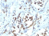 Formalin-fixed, paraffin-embedded human gastric carcinoma stained with PAX6 antibody (PAX6/1166) .