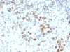 Formalin-fixed, paraffin-embedded human gastric carcinoma stained with PAX-6 antibody (SPM612) .
