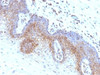 Formalin-fixed, paraffin-embedded human cervical carcinoma stained with B2M antibody (SPM617)