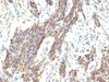 Formalin-fixed, paraffin-embedded human bladder carcinoma stained with Cyclin D1 antibody (CCND1/809) .