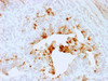 IHC staining of FFPE human ovarian carcinoma with TGF-beta antibody. HIER: boil tissue sections in pH6, 10mM citrate buffer, for 10-20 min and allow to cool before testing.