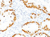 Formalin-fixed, paraffin-embedded human lung Adenocarcinoma stained with TTF1 antibody (NX2.1/690)