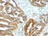 Formalin-fixed, paraffin-embedded human ovarian carcinoma stained with VEGF antibody (VEGF/1063) .