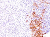 Formalin-fixed, paraffin-embedded human Hodgkin's lymphoma stained with CD30 antibody (SPM609) .