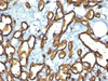 Formalin-fixed, paraffin-embedded human angiosarcoma stained with CD34 antibody (HPCA1/763)