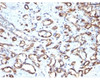 Formalin-fixed, paraffin-embedded human angiosarcoma stained with CD34 antibody (SPM610)