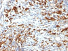 Formalin-fixed, paraffin-embedded human lymphoma stained with CD79a antibody (IGA/764) .